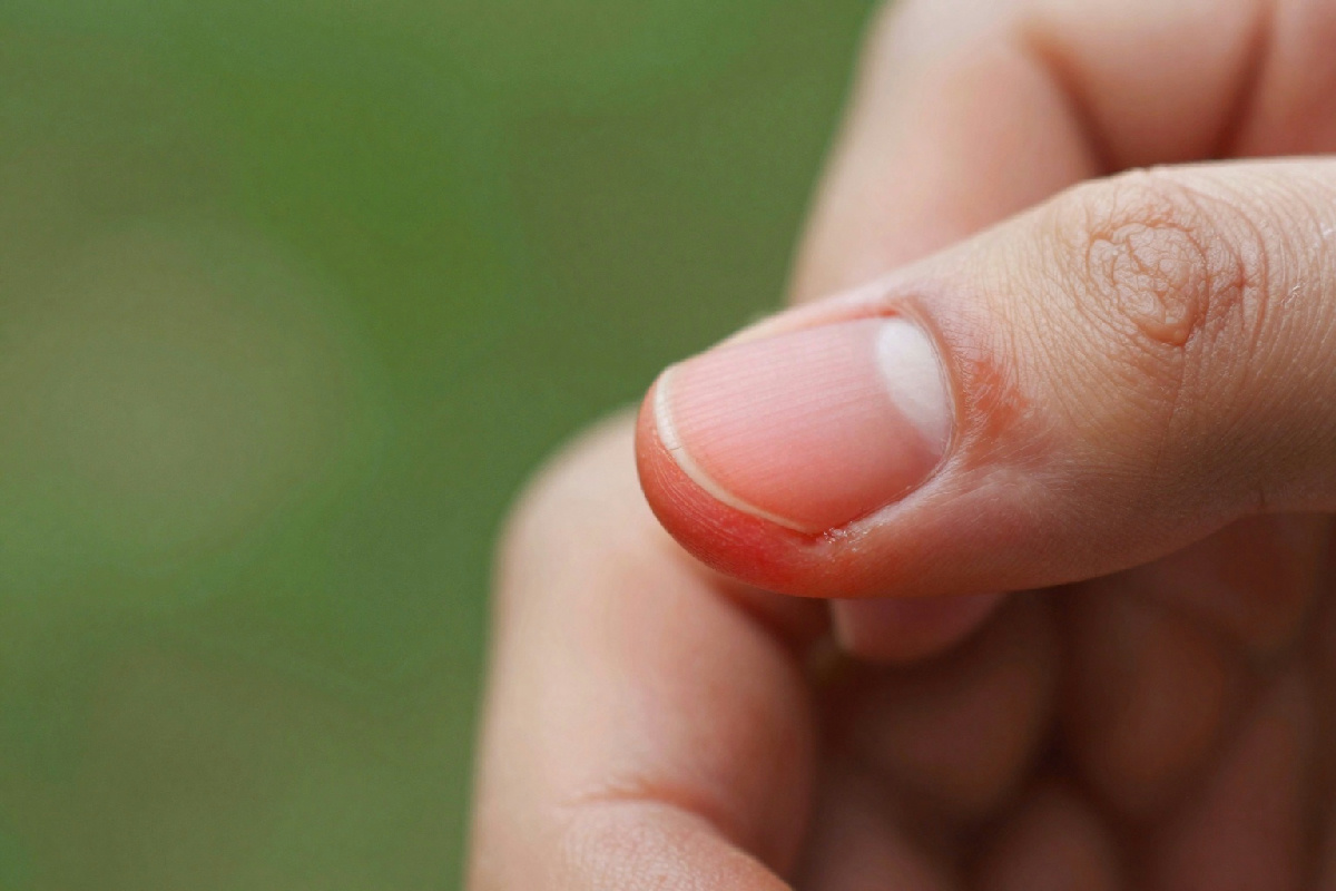 Rimedio naturale per il giradito: ritrova il benessere in modo semplice e veloce